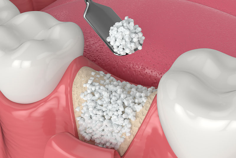 3d illustration of bone grafting procedure