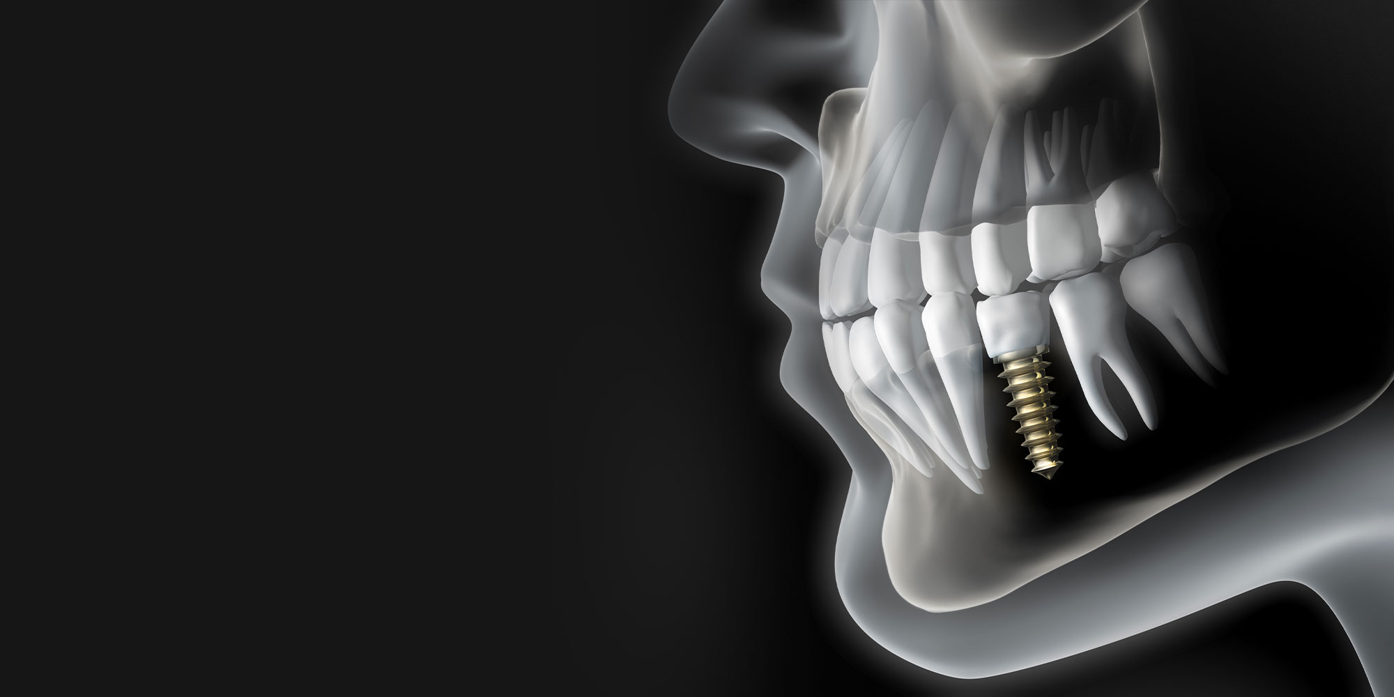 single dental implant graphic