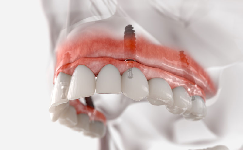 Navigating the Path to Smile Restoration: Unveiling the Secrets of Implants of Teeth